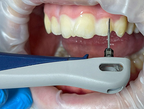 vector durr dental  - лечение дёсен в стоматологической клиннике ДентаЛайф